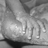 Monkeypox Affenpocken pLandemic summer autumn 2022 (or fake Covid-22)