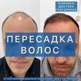 Пересадка волос Владивосток