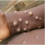 Monkeypox News