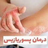 درمان قطعی پسوریازیس و پیسی /خودایمن